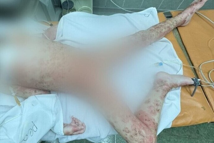 В Липецкой области врачи спасли 4-летнюю девочку после ожогов борщевиком