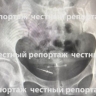 В Башкирии в кишечнике женщины обнаружили иголку