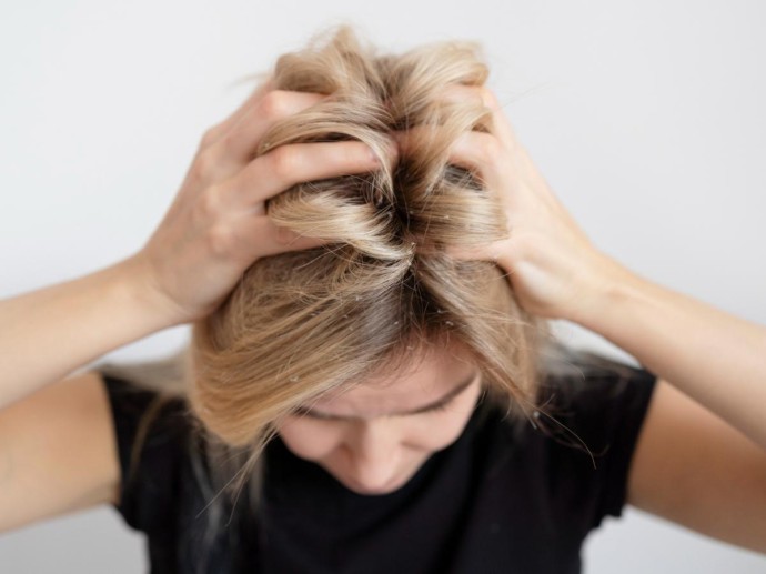 Перхоть атакует миллионы голов: остановить её способна лишь ложка жёлтого порошка Перхоть атакует миллионы голов: остановить её способна лишь ложка жёлтого порошка