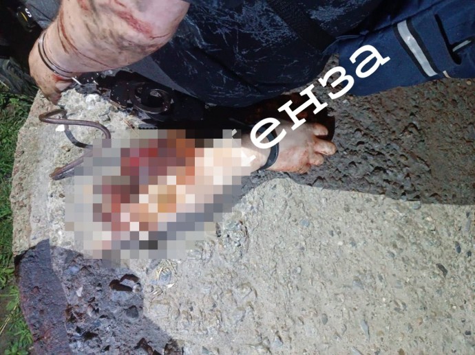 Не для слабонервных: житель Пензенской области гулял по поселку со своей отрезанной рукой
