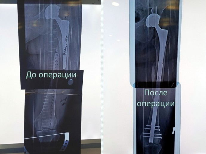 В Кирове помогли пациентке со сложным переломом бедра