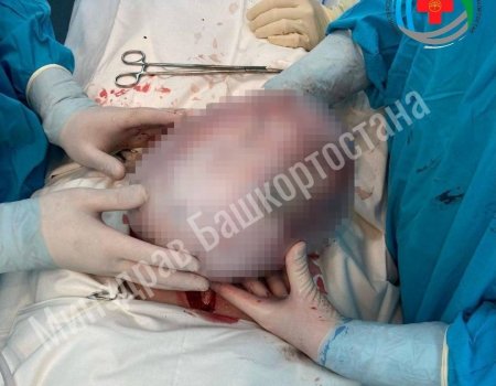 Жительница Башкирии «вынашивала» гигантскую раковую опухоль