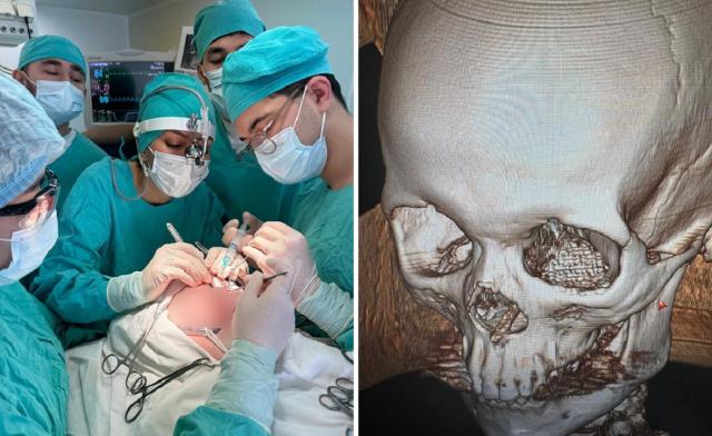 Уфимские врачи восстановили лицо раненому военному при помощи 3D-импланта Уфимские врачи восстановили лицо раненому военному при помощи 3D-импланта