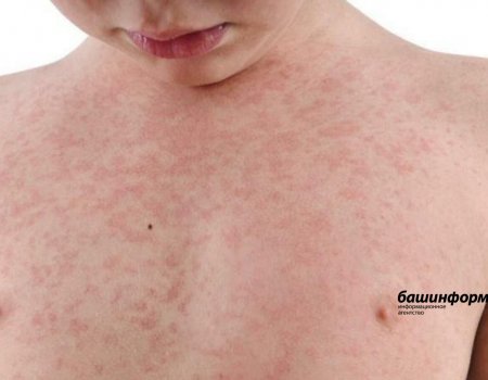 В Башкирии выявлен случай заболевания корью