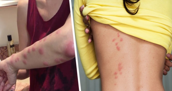 Началась эпидемия завоза клопов туристами: названы страны, опасные для российских путешественников