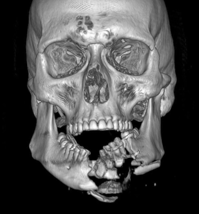 В Приморье врачи собрали «по кусочкам» лица пострадавших в серьезном ДТП