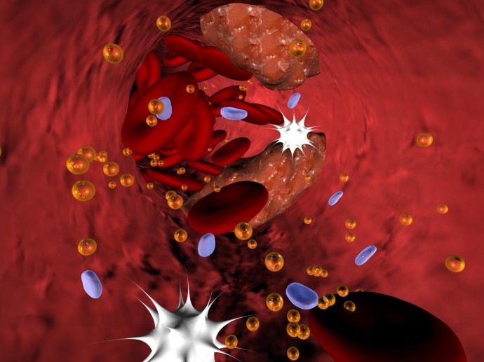 Признаки атеросклероза по давлению выделили кардиологи