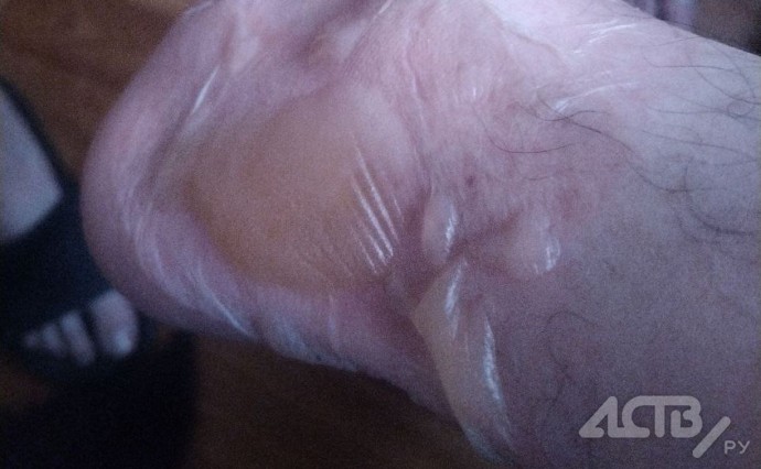 Прокуратура начала проверку после инцидента с ожогом в Южно-Сахалинске Прокуратура начала проверку после инцидента с ожогом в Южно-Сахалинске