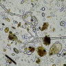 Женщина заразилась неизлечимой болезнью из-за стакана водопроводной воды