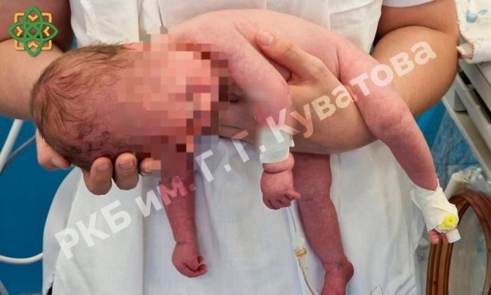 1 случай на 10 000: В Уфе родился малыш с синдромом Прадера-Вилли