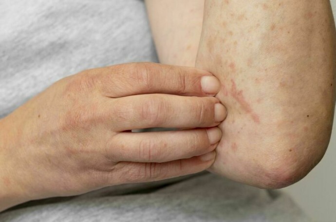 В МГУ выявили случай заболевания корью В МГУ выявили случай заболевания корью