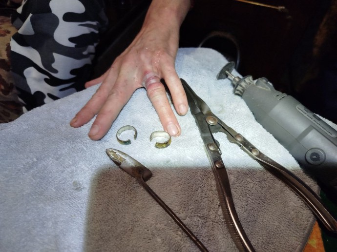 В Пензе кольца с пальца мужчины пришлось снимать спасателям В Пензе кольца с пальца мужчины пришлось снимать спасателям