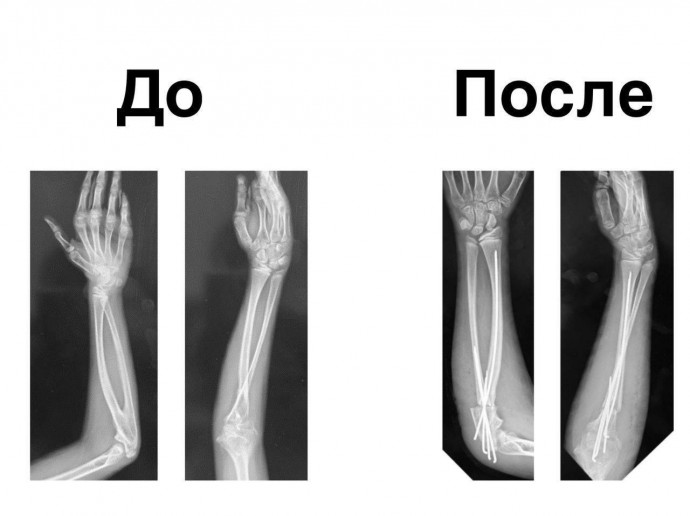 Ребенка с врожденной аномалией руки спасли в медцентре Рошаля