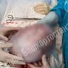 Врачи в Уфе удалили 67-летней пациентке огромную опухоль