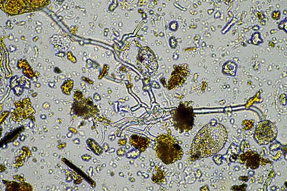 Женщина заразилась неизлечимой болезнью из-за стакана водопроводной воды