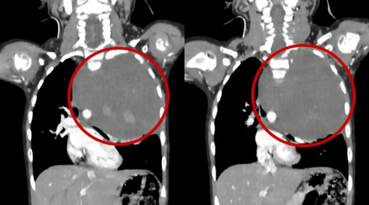 Врачи РДКБ Минздрава России удалили девочке опухоль размером со страусиное яйцо