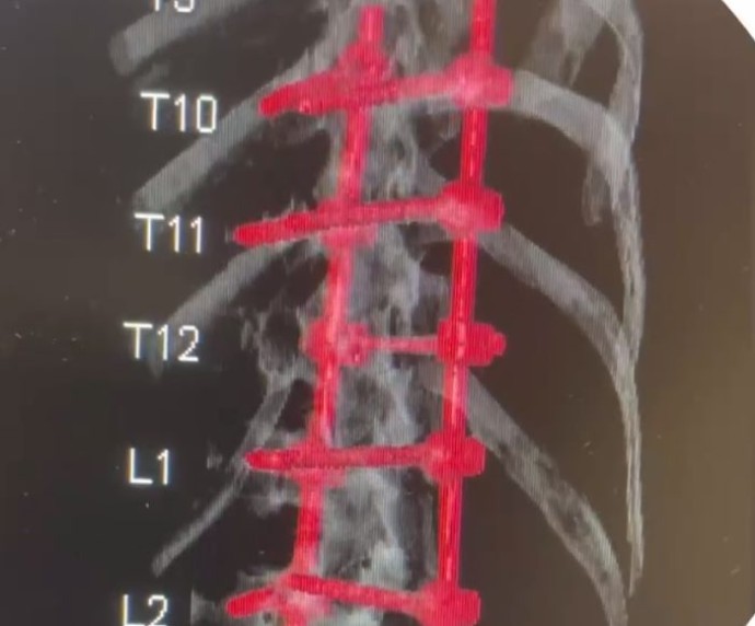 Падение с высоты своего роста обернулось для жителя Бурятии серьёзной операцией Падение с высоты своего роста обернулось для жителя Бурятии серьёзной операцией