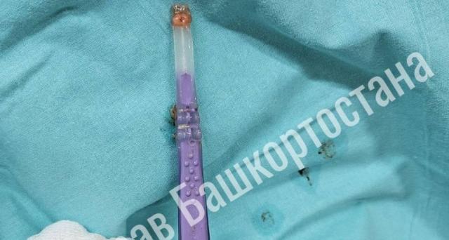 В Уфе врачи извлекли из пищевода пациента зубную щетку В Уфе врачи извлекли из пищевода пациента зубную щетку