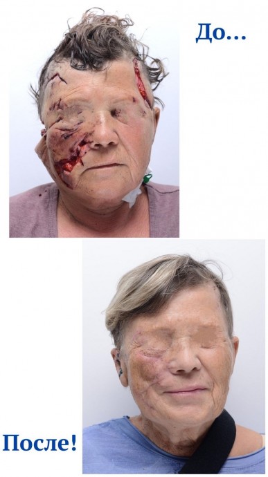 Алабай изуродовал лицо приморской пенсионерки, но хирурги его «собрали по кусочкам» Алабай изуродовал лицо приморской пенсионерки, но хирурги его «собрали по кусочкам»