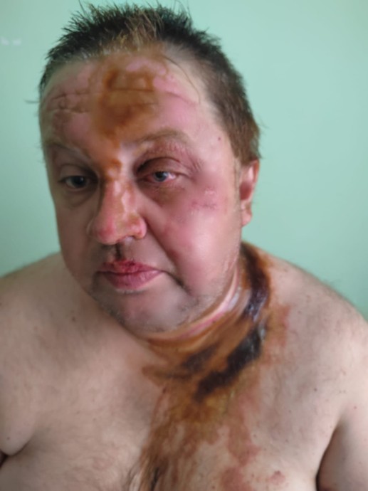 Избитый в августе Игорь Ронжин проходит лечение, расследование покушения продолжается