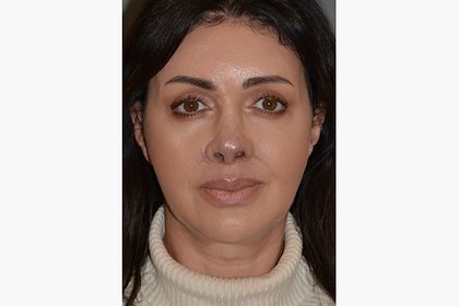 Хирург показал новые фото экс-жены Аршавина после курса по восстановлению носа