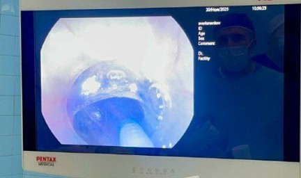 Не могла проглотить даже воду: в НИИ скорой помощи им. И.И. Джанелидзе помогли пациентке с редкой патологией пищевода