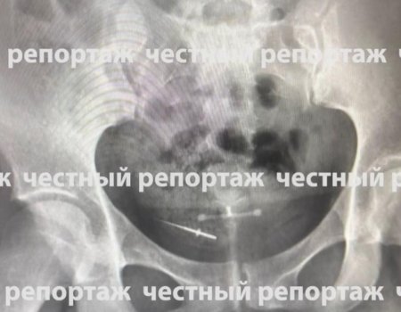 В Башкирии в кишечнике женщины обнаружили иголку